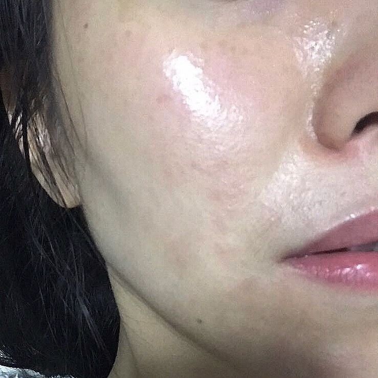 在美容店洗脸过敏怎么维权赔付,美容店洗脸过敏可以赔偿吗