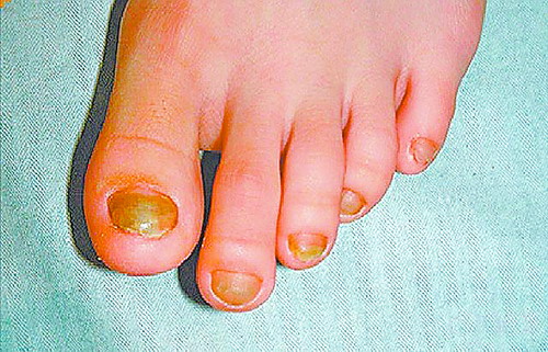 儿童长期少量吞食牙膏,孩子刷牙后咬指甲