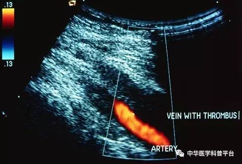 长血栓吃什么药最好,长血栓