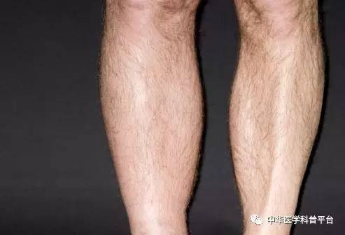 长血栓吃什么药最好,长血栓