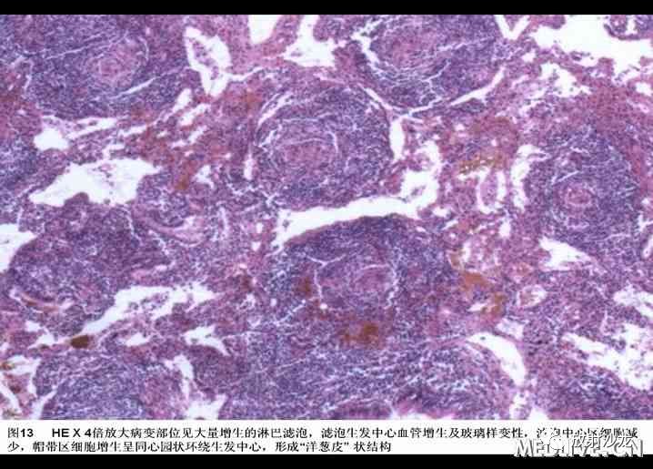 双肺实性小结节考虑炎症肉芽肿,双肺多发恶性肺结节100多个