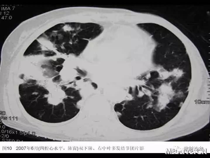 双肺实性小结节考虑炎症肉芽肿,双肺多发恶性肺结节100多个
