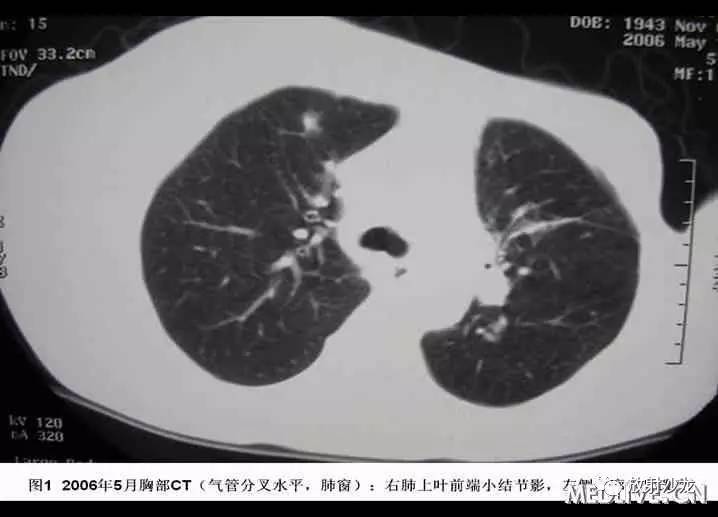 双肺实性小结节考虑炎症肉芽肿,双肺多发恶性肺结节100多个