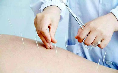 美国医师学会:针灸推荐为治疗急慢性腰痛的唯一一线疗法