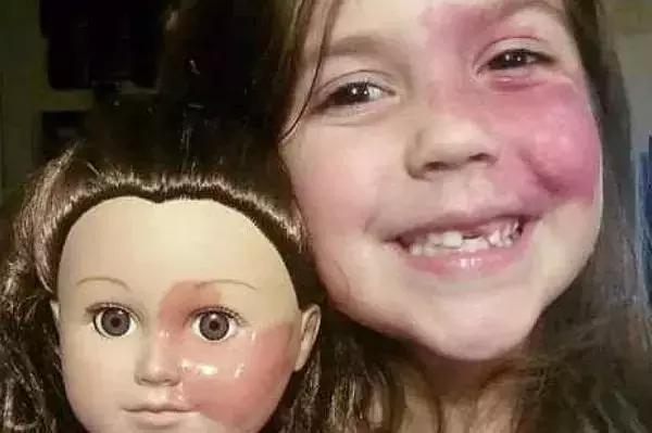 女儿有红胎记,妈妈是这样做的!