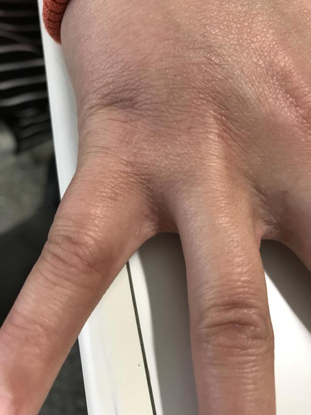 宝宝身上传染疥疮如何彻底根除,一岁宝宝传染疥疮怎么治