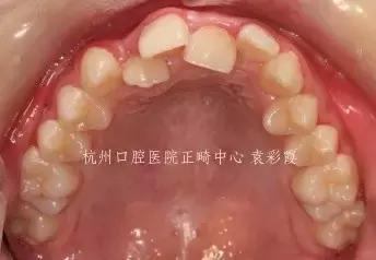 龅牙深覆合矫正效果,26岁了深覆合龅牙还能矫正吗