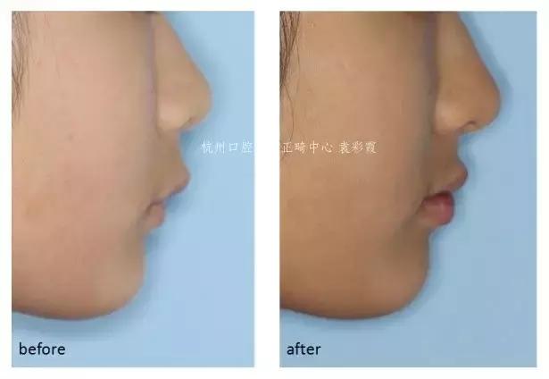 龅牙深覆合矫正效果,26岁了深覆合龅牙还能矫正吗