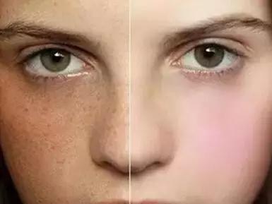 脸色痘印残留的黑色怎么才能消除,斑点痘印皮肤暗沉怎么改善