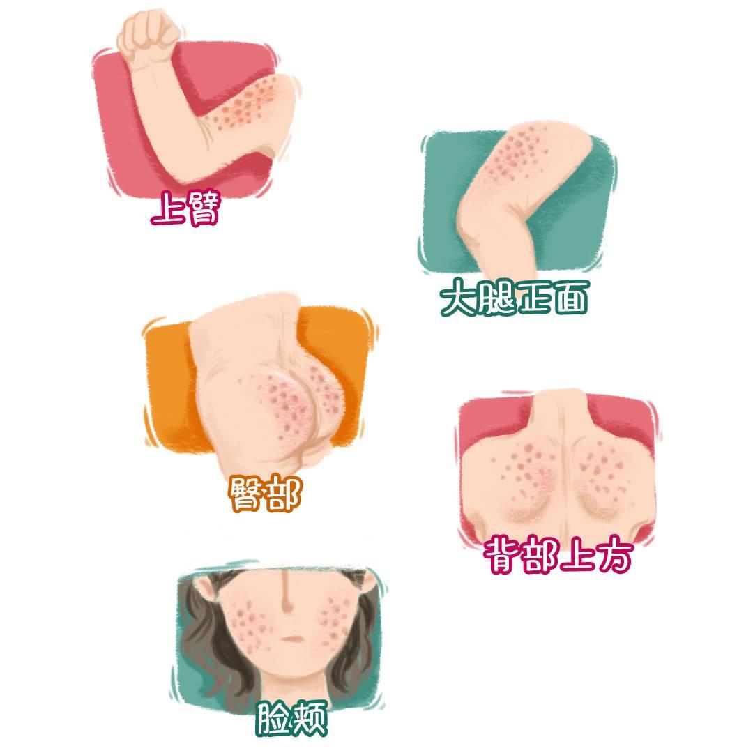 皮肤起红疹老不好用什么药,皮肤上有红点怎么调理