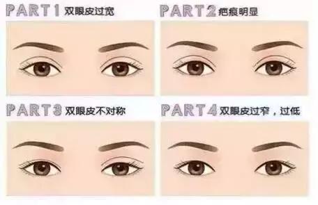 割一个双眼皮去哪做修复,修复3000块的双眼皮你敢做吗
