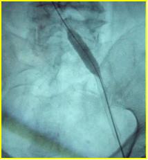 下肢肿胀有效的治疗手段是什么？