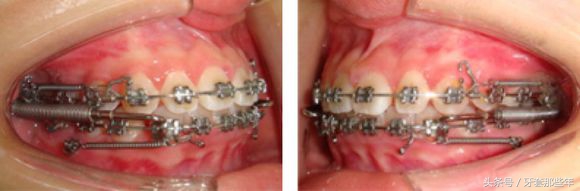 戴牙套矫正要打骨钉吗,矫正先拔牙还是先戴牙套
