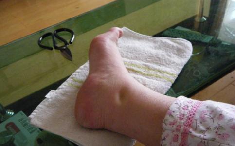 孕期小腿浮肿如何缓解,小腿浮肿是怎么回事