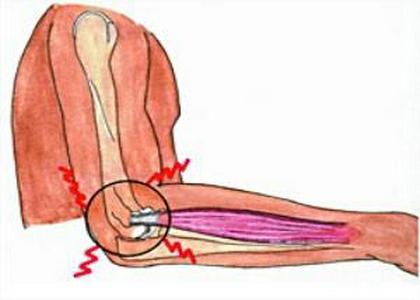 灸哥论穴：用艾灸疗法调理网球肘
