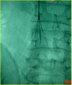 下肢肿胀有效的治疗手段是什么？
