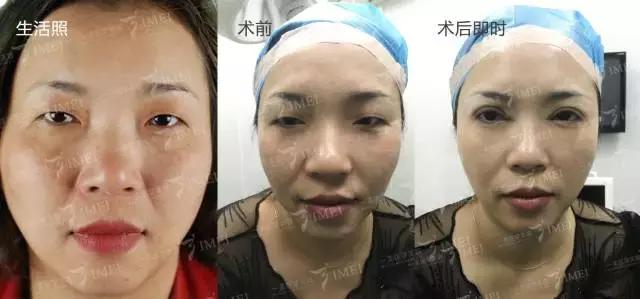 割一个双眼皮去哪做修复,修复3000块的双眼皮你敢做吗