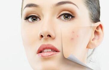 想做无痘美人三招教你简单祛痘,祛痘小妙招让你告别痘痘做女神