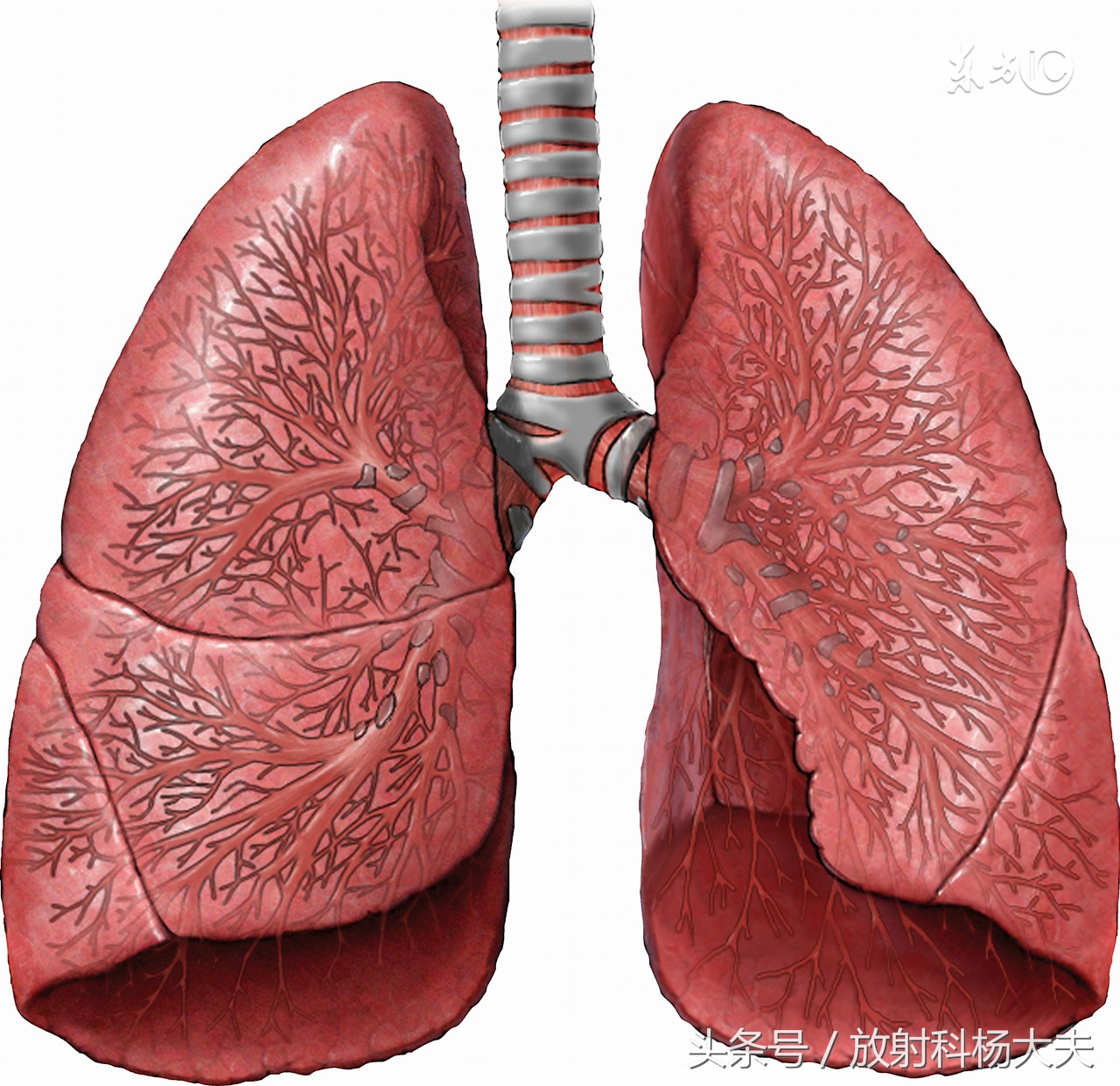 千变万化的表现,指套征的影像诊断意义