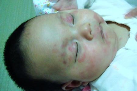 宝宝得奶癣怎么治,宝宝奶癣反反复复有什么办法