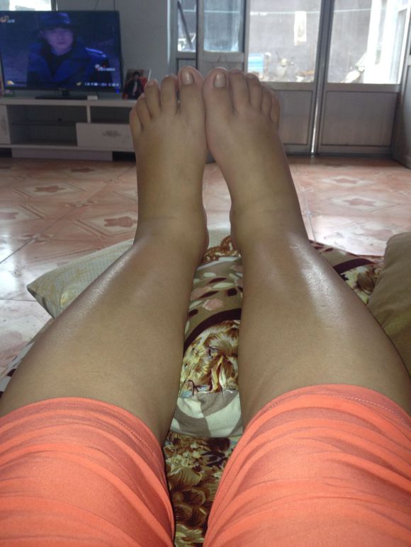 孕期小腿浮肿如何缓解,小腿浮肿是怎么回事