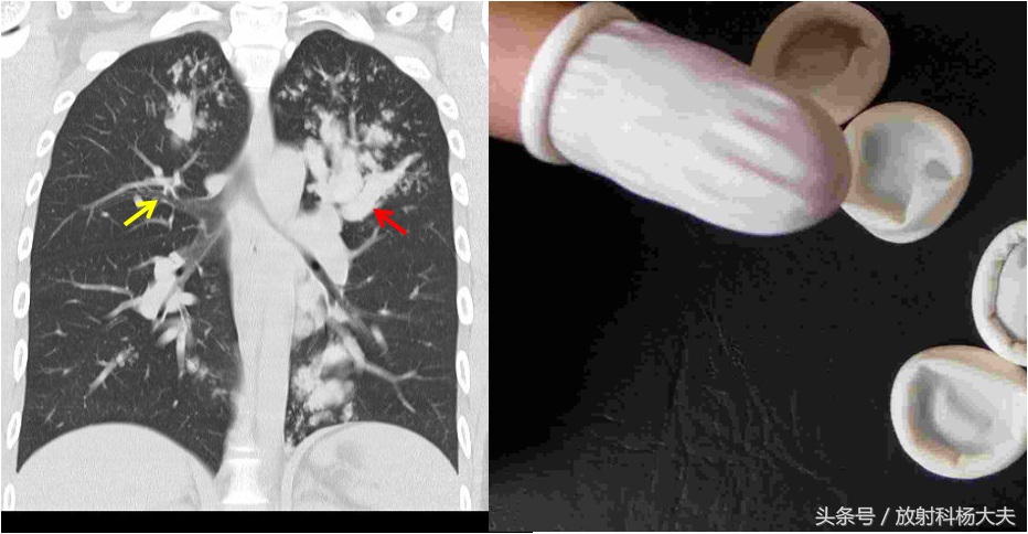 千变万化的表现,指套征的影像诊断意义