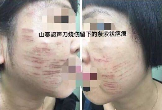超声刀美容危害,正版超声刀与山寨超声刀的区别