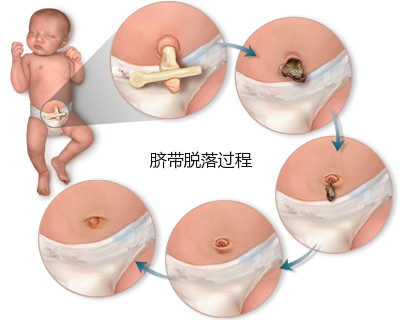 护理好新生儿的脐带残端