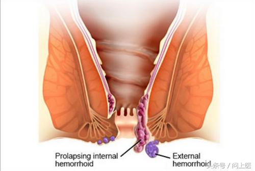 痔疮不管它有什么后果,痔疮患者需要了解的事