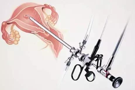 妇科腔镜姐妹俩——宫腔镜和腹腔镜