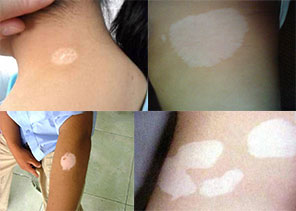 白癜风早期会有小米粒疙瘩吗,儿童白癜风早期治愈率90%