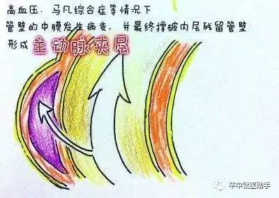 a型主动脉夹层是什么原因引起的,主动脉夹层b型支架对寿命的影响