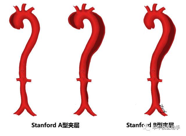 a型主动脉夹层是什么原因引起的,主动脉夹层b型支架对寿命的影响