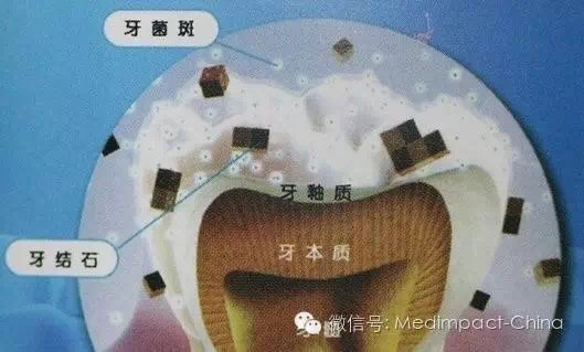 洗牙能得艾滋病吗,洗牙真的会感染艾滋乙肝吗