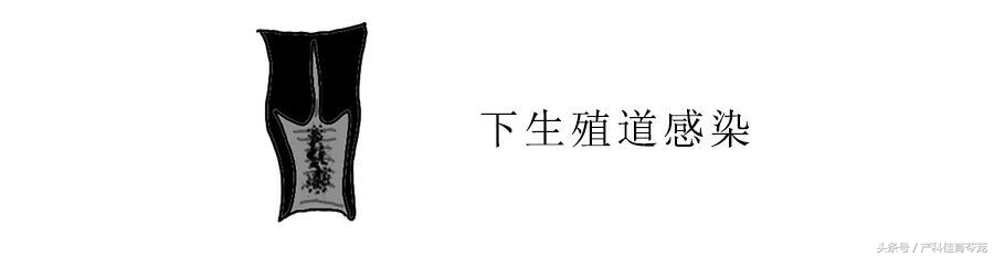 治疗盆腔炎要趁早！不然有大事发生