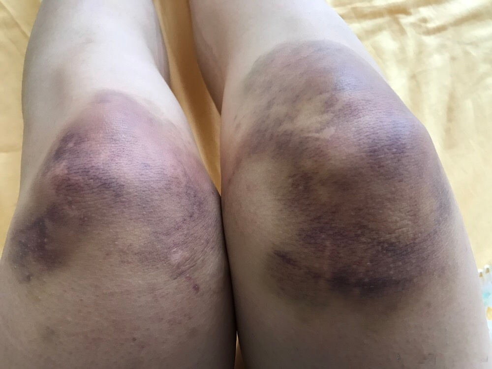 运动员的背后你知多少？训练练到双膝红肿淤青，甚至脚趾盖磨掉！