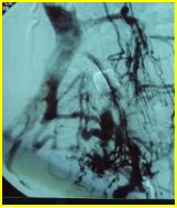 下肢肿胀有效的治疗手段是什么？