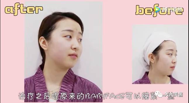 视频|还没到30,皮肤松弛了?不开刀也不疼的射频提升?