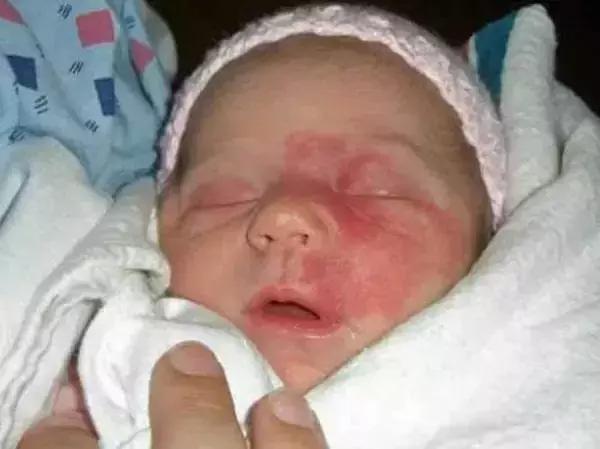 女儿有红胎记,妈妈是这样做的!