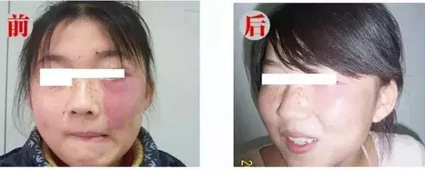 女儿有红胎记,妈妈是这样做的!