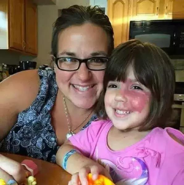 女儿有红胎记,妈妈是这样做的!