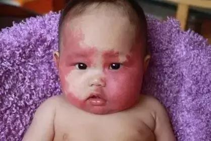 女儿有红胎记,妈妈是这样做的!
