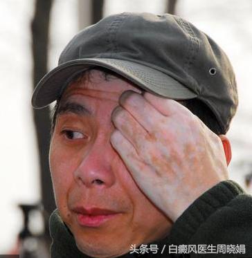 白癜风明星有哪些,白癜风明星