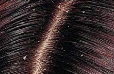 严重的头皮屑怎么也去不掉怎么办,头皮屑一直去不掉怎么办