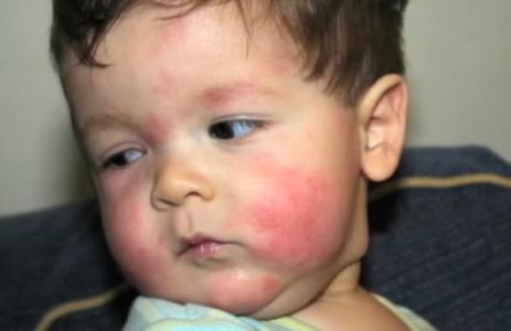 宝宝得奶癣怎么治,宝宝奶癣反反复复有什么办法