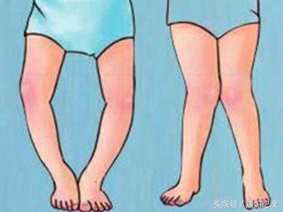 宝宝o型腿矫正方法,宝宝o型腿矫正全过程