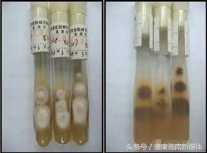 为什么三个月的婴儿都是灰指甲,指甲发黄警惕灰指甲