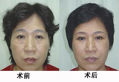 超声刀美容危害,正版超声刀与山寨超声刀的区别