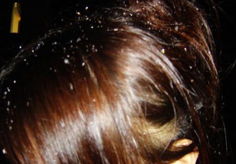 去头屑二硫化硒洗剂,怎么去头屑又快又好