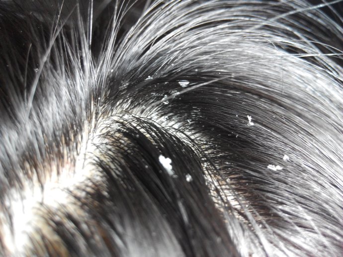 去头屑二硫化硒洗剂,怎么去头屑又快又好